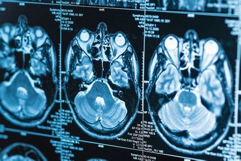 the villages mri brain|Diagnostic Radiology .